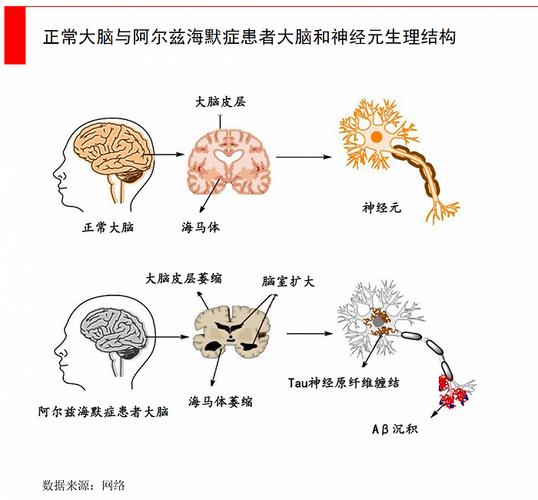 阿尔茨海默征兆(阿尔茨海默的病因)